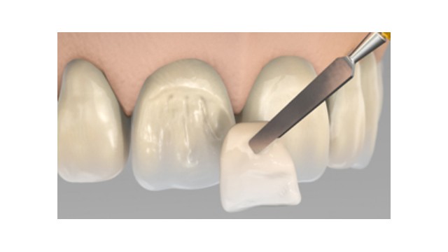 Veneer composiet