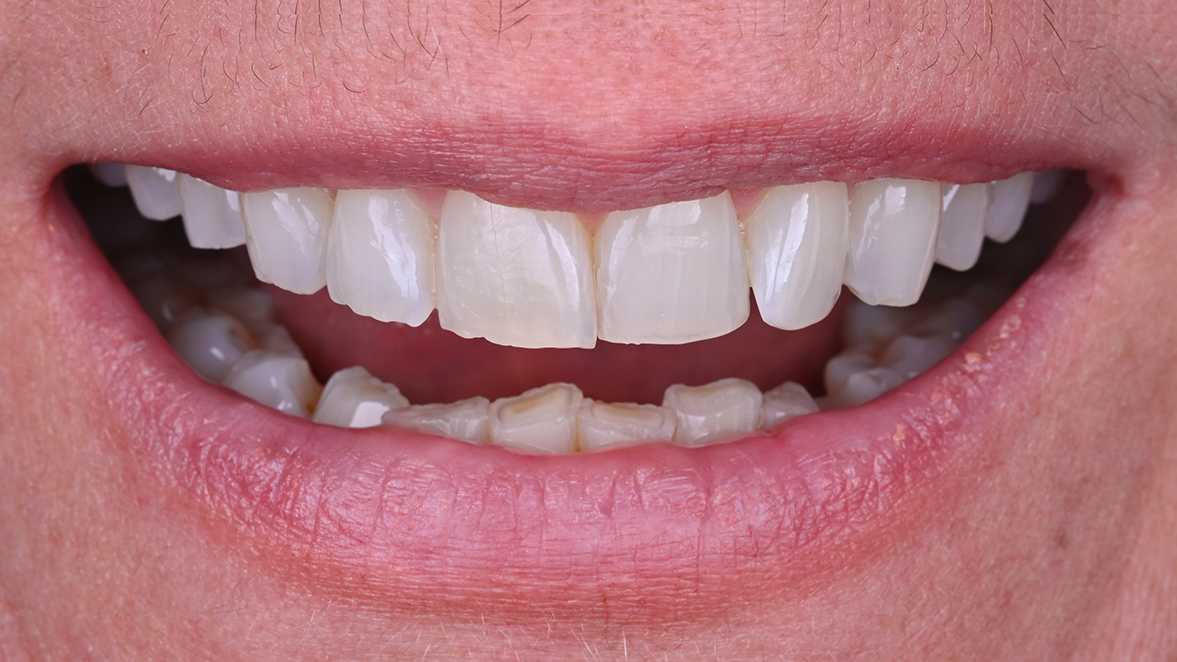 Kulzer Vivida_Case door Dr. Edoardo Fossati, Italië_na